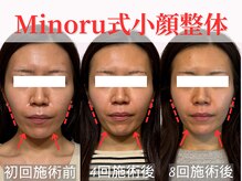 フレキシボディ(FlexiBody)/小顔施術ビフォーアフター #20