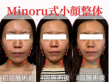 フレキシボディ(FlexiBody)/小顔施術ビフォーアフター #20