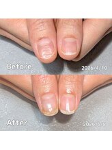 サロンペペ(salon pepe)/ボコボコ生えてくる爪