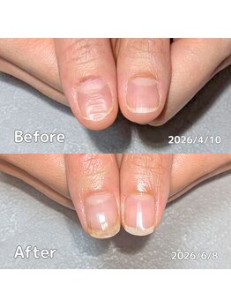 サロンペペ(salon pepe)/ボコボコ生えてくる爪