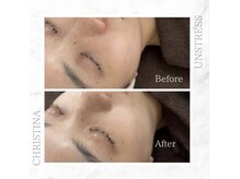 シャルムパリス(charme paris)/初ピーリング☆１回の施術変化