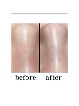 エクスクラメーションマーク(!!!)/プラズマフェイシャル