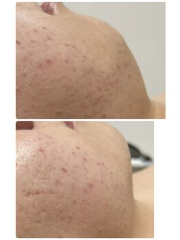 ビジュープラス 幸手店(Bijou+)/毛穴・ニキビケア