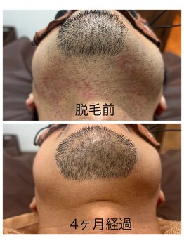アカラ 読谷店(AKALA)/ヒゲ脱毛4か月経過