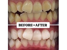 ホワイトニングサロン 豊中/Before&After美白ホワイトニング