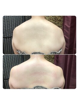 アールズ 南風原(R’s)/巻き肩/なで肩改善