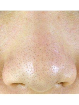 花銀クラブ(花銀Club)/毛穴黒ずみDetoxコース 施術前→