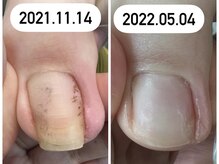 エスネイル(S Nail)/巻き爪ケア/巻き爪補正