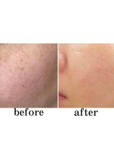 エクスクラメーションマーク(!!!)/プラズマフェイシャル