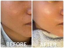 ハーブピーリング 恵比寿/毛穴/くすみ/シミ改善