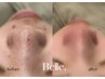 【毛穴ケア】頑固な毛穴黒ずみに◎満足度100%！即日「毛穴レス肌セット」