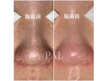 パル(PAL)の雰囲気（毛穴の汚れ丸ごとお掃除☆大人気☆毛穴エクストラクション◎）