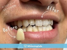 ホワイトニングカフェ 高松丸亀町グリーン店(WhiteningCafe)/◎歯のホワイトニング施術写真◎