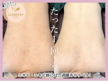 アッシュ 梅田(H)/ハーブピーリング専門Hアッシュ