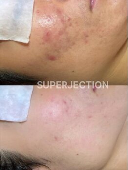 エムケーサロン(MK salon)/#スーパージェクション