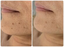 クレビア(CREBIA)の雰囲気(シミ/シミケア/シミ改善/韓国発プラズマ/プラペン/臍帯血/那覇市)