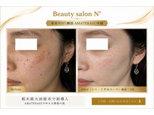 ナンバー(N°)の雰囲気（シミ・くすみコース￥15000→11900）