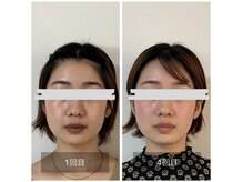鍼灸院 はりのひと/美容鍼4回のビフォーアフター