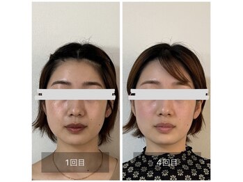 鍼灸院 はりのひと/美容鍼4回のビフォーアフター