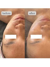 ルシェリア(Le cherien)/陶肌トリートメント