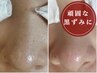 【回数券ご購入のお客様】毛穴エクストラクションプロ¥0