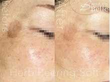 ベル 新潟(Belle)/ハーブピーリング|シミケア