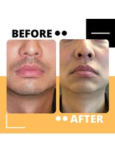 アルジェンヌ 五井店/メンズ脱毛　before/after