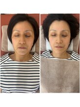 鍼灸サロン ヒマワリ(himawari)/美容鍼 左before 右after