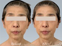 バウムユー 銀座店(baum.u)/無重力リフトBefore After