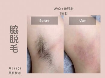 アルゴ 山口宇部店(ALGO)/即日!脇脱毛+WAX