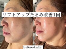 プラウディア(PROUDIA)/大人気茨城希少ハーブピーリング