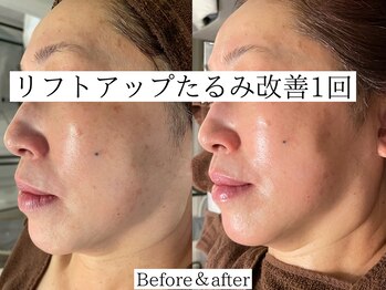 プラウディア(PROUDIA)/茨城希少ハーブピーリング肌悩み