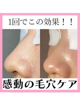 レイ エステティック 江南店(RAY ESTHETIC)/毛穴洗浄×顔脱毛