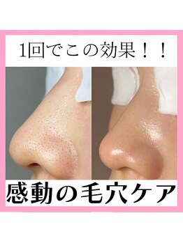 レイ エステティック 江南店(RAY ESTHETIC)/毛穴洗浄×顔脱毛