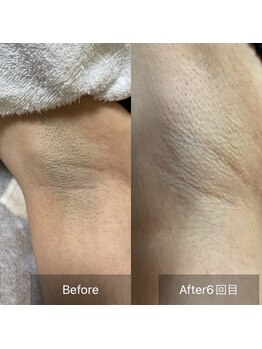 キーオブフェイス(Key of Face)/お悩み【ワキが青い】