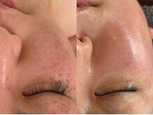 ハチ(Hachi)/＊臍帯＆羊膜幹細胞上清液＊