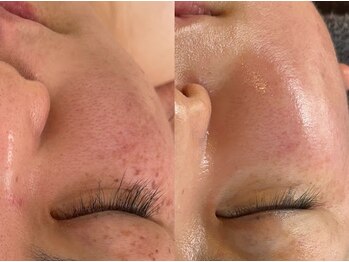 ハチ(Hachi)/＊臍帯＆羊膜幹細胞上清液＊