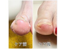 グレイス(GRACE)の雰囲気（長年の巻き爪が改善）