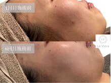 ラヴィオーラ 西大寺(La Viora)/ダイヤモンドハーブピーリング