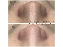 ジュエカフネ 広尾(JueCAFUNe)/乾燥による開き毛穴もふっくら