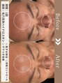 ファッショニスタ 恵比寿東口(Fashionista) 【メニュー:ハイドロ/期間:1回/悩み:くすみ・毛穴開き】