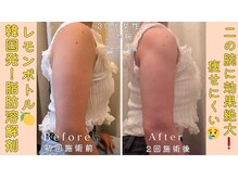 痩せにくい二の腕も-2.8cm!韓国発「脂肪分解剤」レモンボトル♪