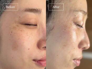 キュレイテッドスキン(CURATED SKIN)/ピーリング/毛穴ケア/肌質改善