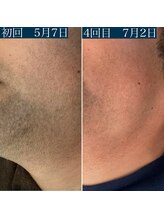 エクラ アン(eclat.un)/年間パスポート　ヒゲ脱毛　男性