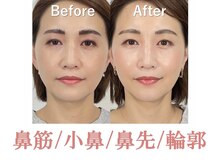 ラプリ 仙台店(Raplit stella)/隆鼻矯正+輪郭40分 10回