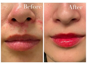 アブニールブリヨン/2BBioハーブピーリング/肌質改善