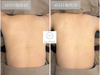 ラヴィオーラ 西大寺(La Viora)/ダイヤモンドハーブピーリング