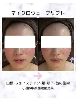 ベルラ(BELLRA)/最先端リフトのマイクロ波