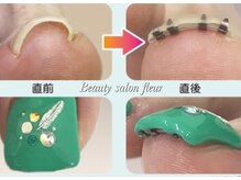 ビューティーサロンフルール(fleur)/巻き爪矯正¥3,850