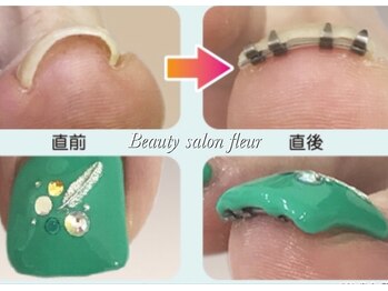 ビューティーサロンフルール(fleur)/巻き爪矯正¥3,850